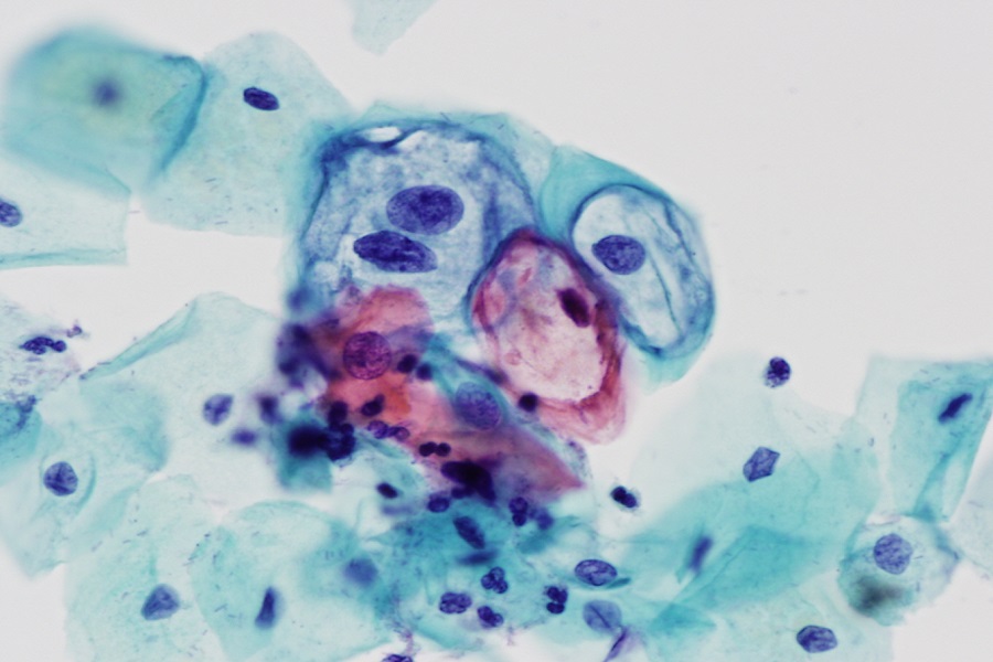 Cytopathologie : le rôle du frottis dans le dépistage précoce